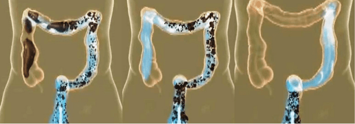 What Is Colon Hydrotherapy Treatment? 2 Colon Hydrotherapy Treatment
