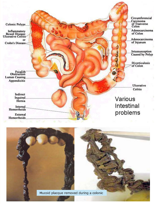What to Do to Clean Your Colon?